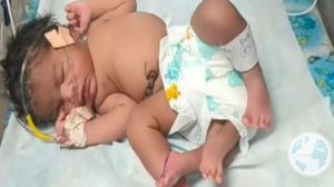A 4-Legged Baby Girl was Born in India